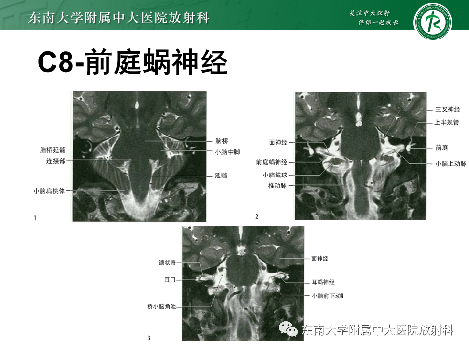 影像PPT - 【PPT】蜗神经发育不良-22 影像PPT - 【PPT】蜗神经发育不良-22