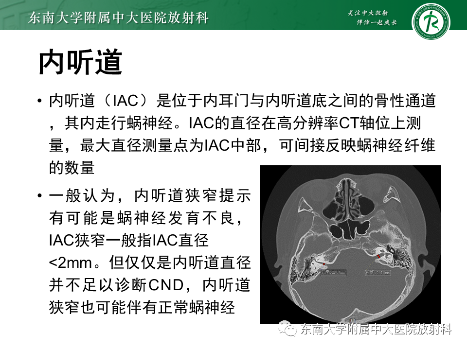 影像PPT - 【PPT】蜗神经发育不良-27 影像PPT - 【PPT】蜗神经发育不良-27