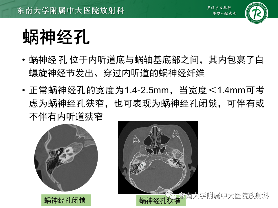 影像PPT - 【PPT】蜗神经发育不良-30 影像PPT - 【PPT】蜗神经发育不良-30