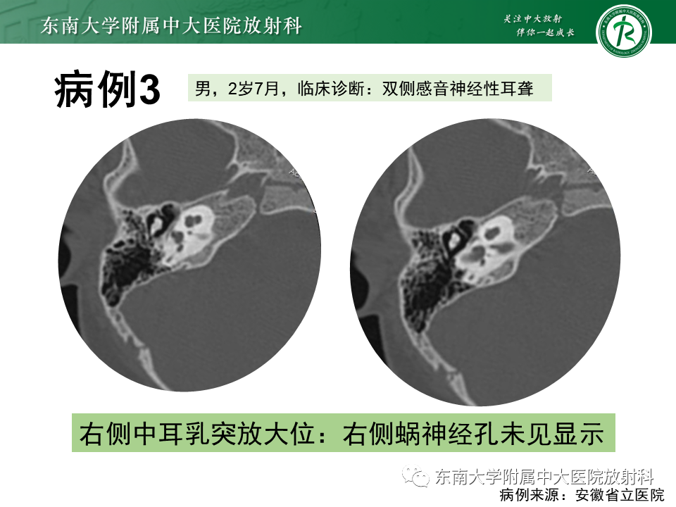 影像PPT - 【PPT】蜗神经发育不良-31 影像PPT - 【PPT】蜗神经发育不良-31
