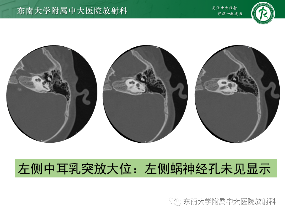 影像PPT - 【PPT】蜗神经发育不良-32 影像PPT - 【PPT】蜗神经发育不良-32