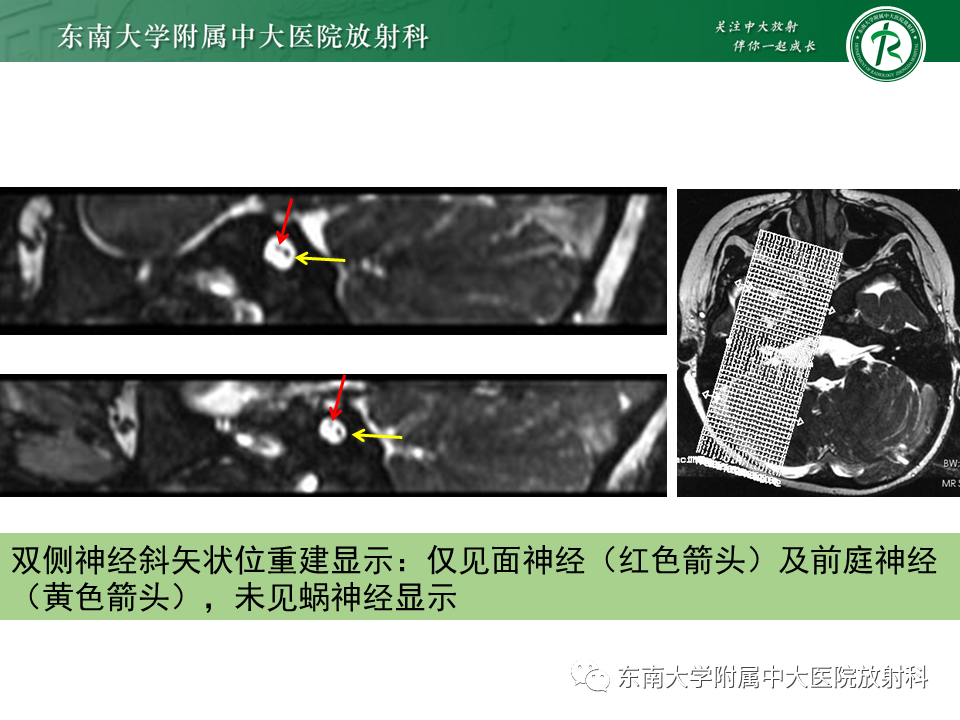 影像PPT - 【PPT】蜗神经发育不良-33 影像PPT - 【PPT】蜗神经发育不良-33