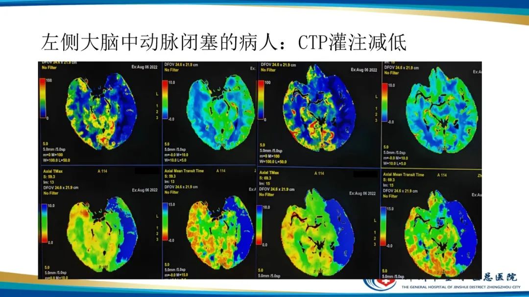 影像PPT - 【PPT】颅脑CT灌注成像及临床应用-14