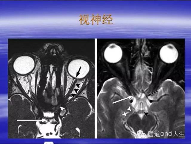 影像PPT - MRI图像中可以看到的八条颅神经-3 影像PPT - MRI图像中可以看到的八条颅神经-3