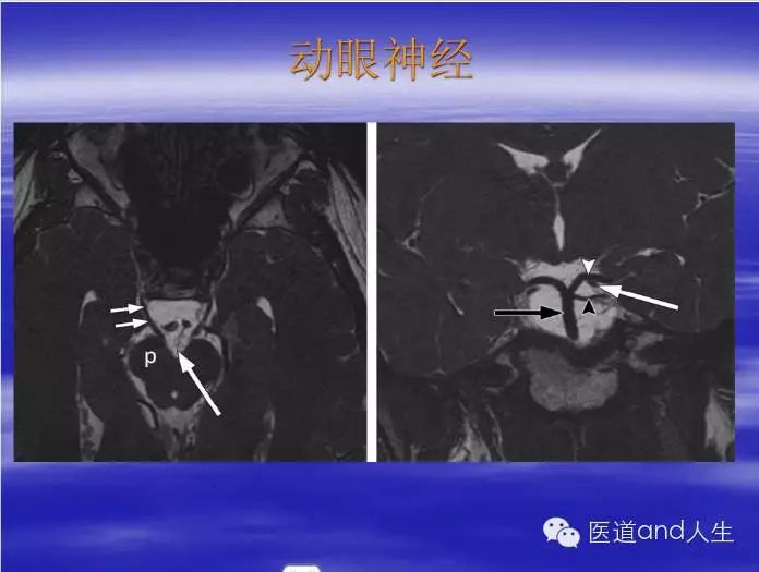 影像PPT - MRI图像中可以看到的八条颅神经-4 影像PPT - MRI图像中可以看到的八条颅神经-4