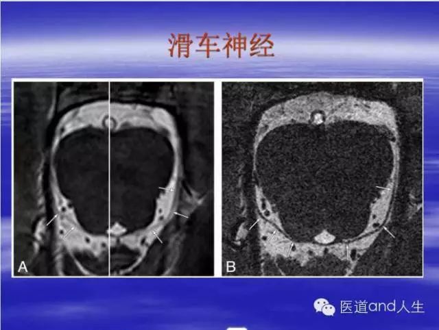 影像PPT - MRI图像中可以看到的八条颅神经-5 影像PPT - MRI图像中可以看到的八条颅神经-5
