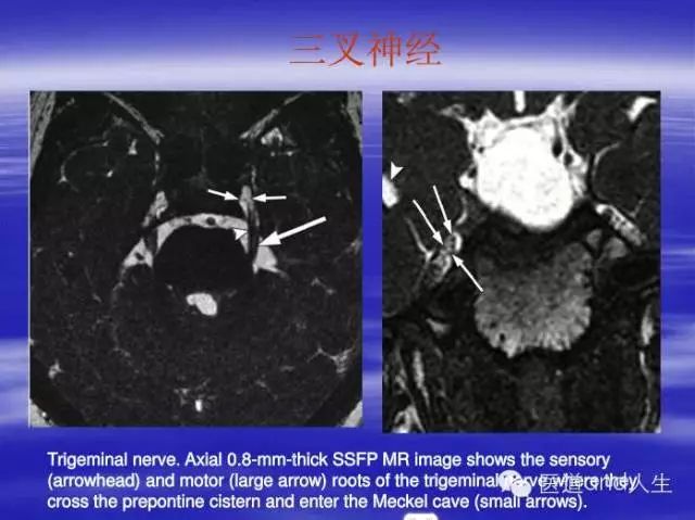 影像PPT - MRI图像中可以看到的八条颅神经-6 影像PPT - MRI图像中可以看到的八条颅神经-6