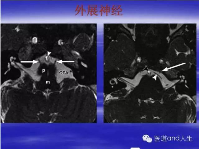 影像PPT - MRI图像中可以看到的八条颅神经-7 影像PPT - MRI图像中可以看到的八条颅神经-7