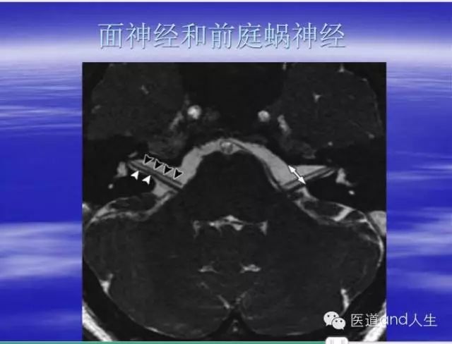 影像PPT - MRI图像中可以看到的八条颅神经-8 影像PPT - MRI图像中可以看到的八条颅神经-8