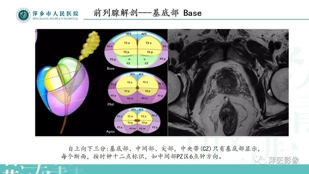 影像PPT - 【PPT】前列腺癌影像诊断-10