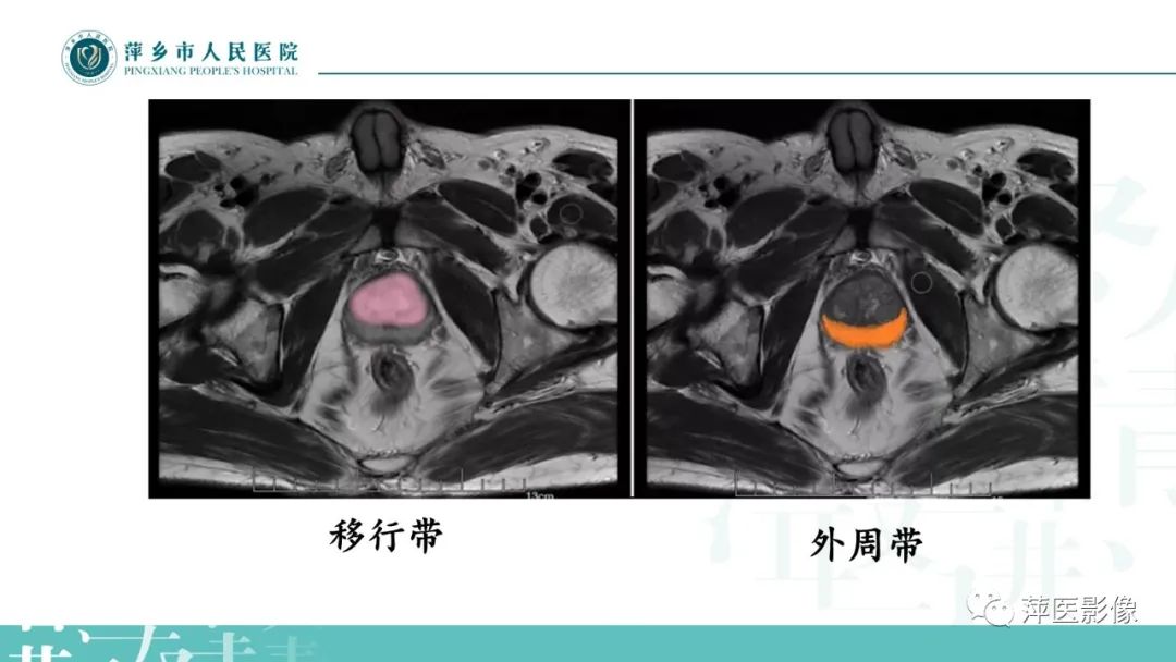 影像PPT - 【PPT】前列腺癌影像诊断-9
