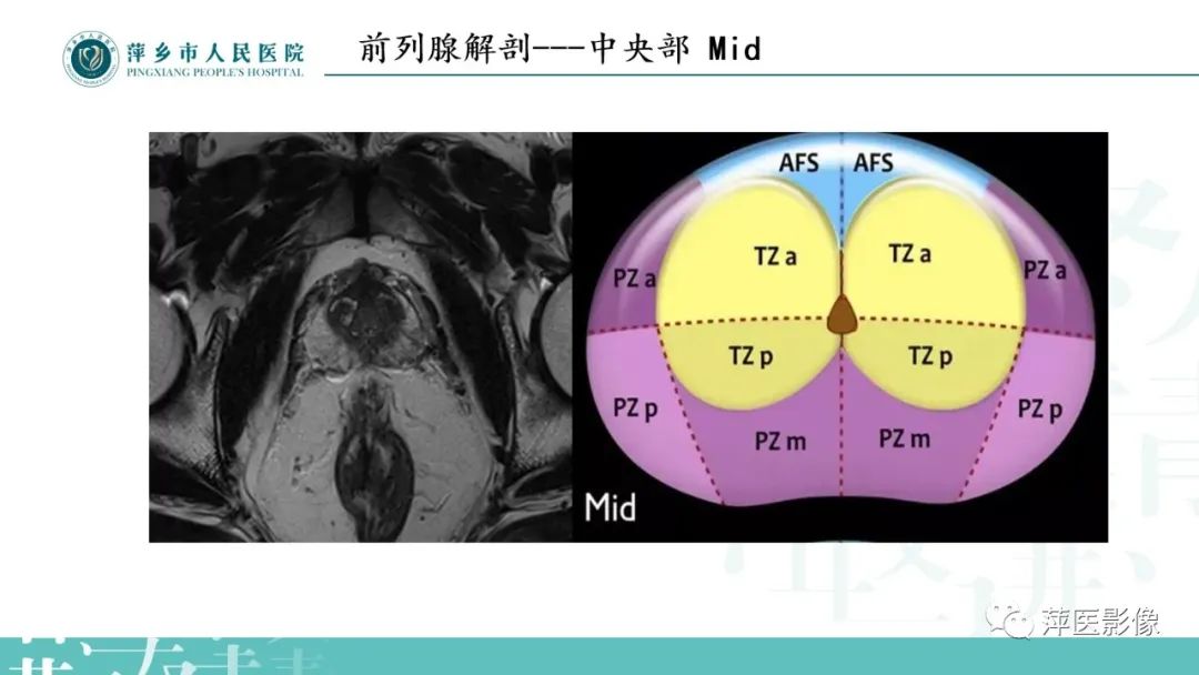 影像PPT - 【PPT】前列腺癌影像诊断-11