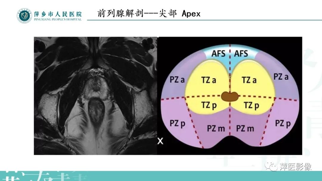 影像PPT - 【PPT】前列腺癌影像诊断-12