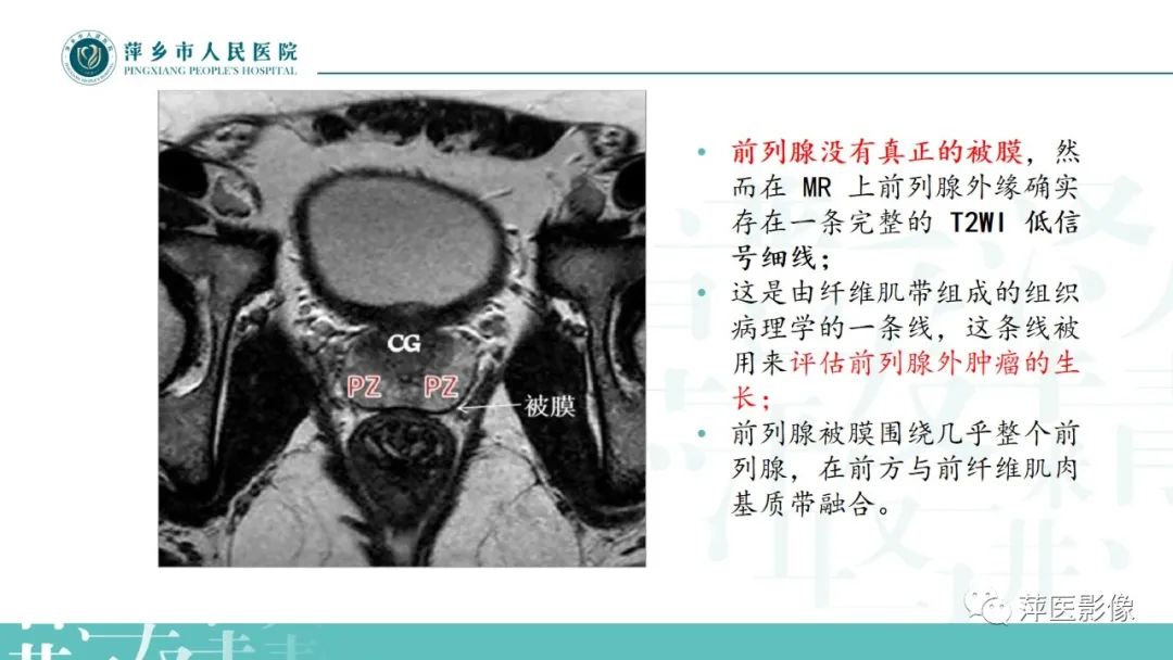 影像PPT - 【PPT】前列腺癌影像诊断-13