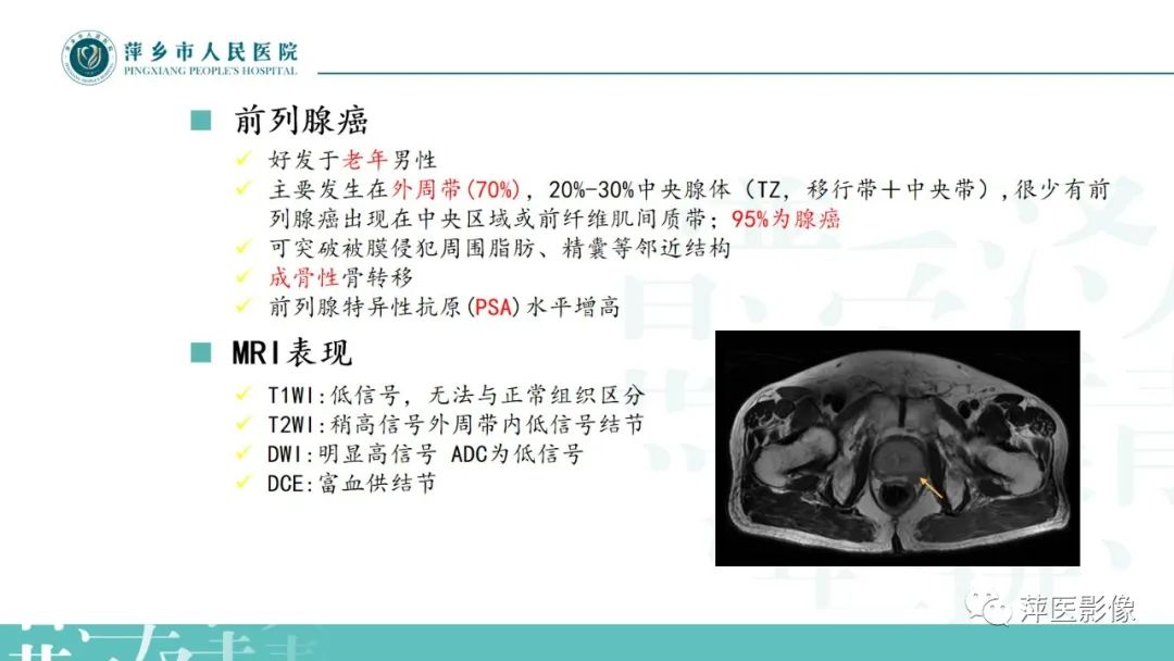 影像PPT - 【PPT】前列腺癌影像诊断-14