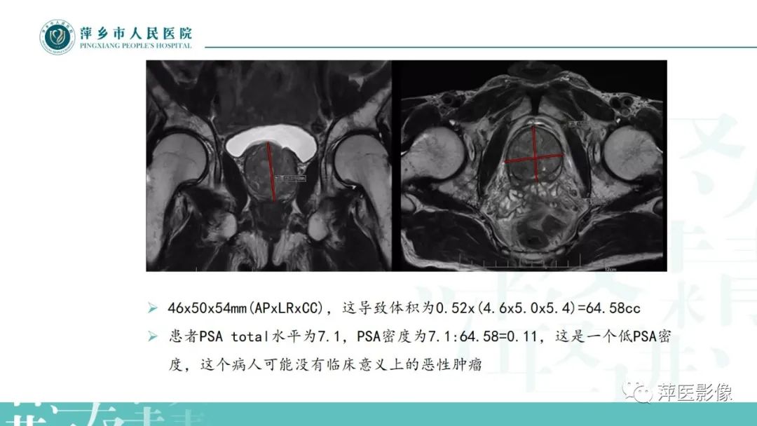 影像PPT - 【PPT】前列腺癌影像诊断-17