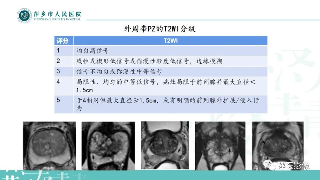 影像PPT - 【PPT】前列腺癌影像诊断-19