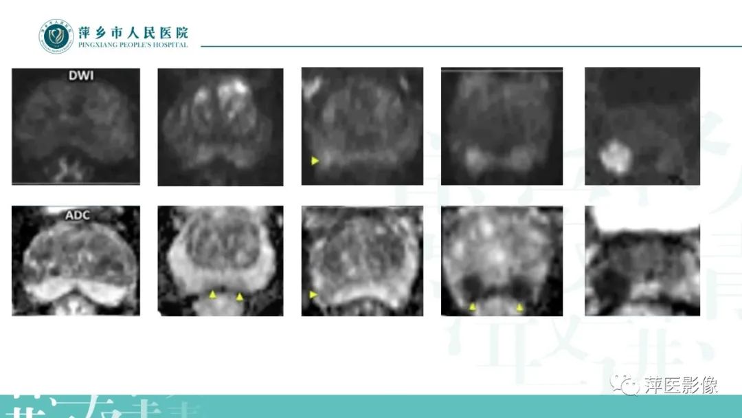 影像PPT - 【PPT】前列腺癌影像诊断-22