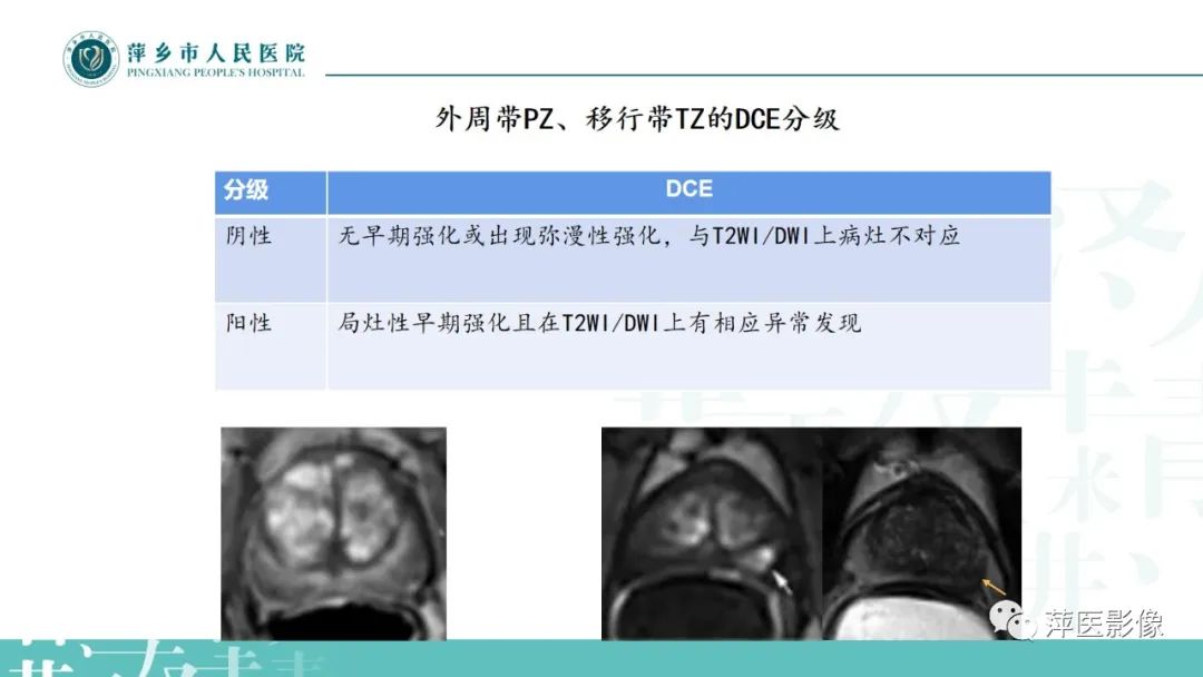 影像PPT - 【PPT】前列腺癌影像诊断-23