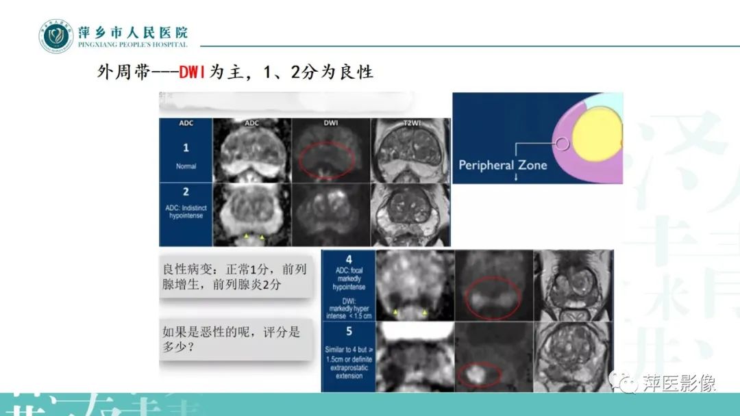 影像PPT - 【PPT】前列腺癌影像诊断-25