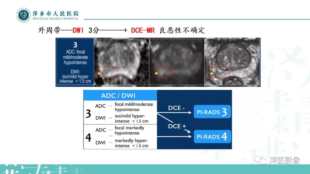 影像PPT - 【PPT】前列腺癌影像诊断-26