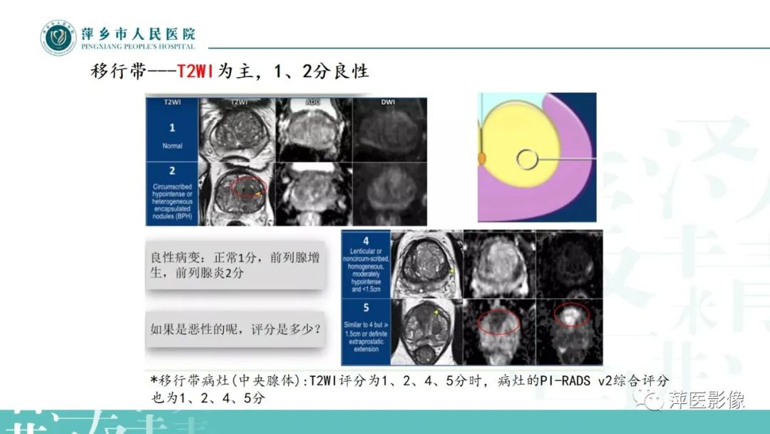 影像PPT - 【PPT】前列腺癌影像诊断-28