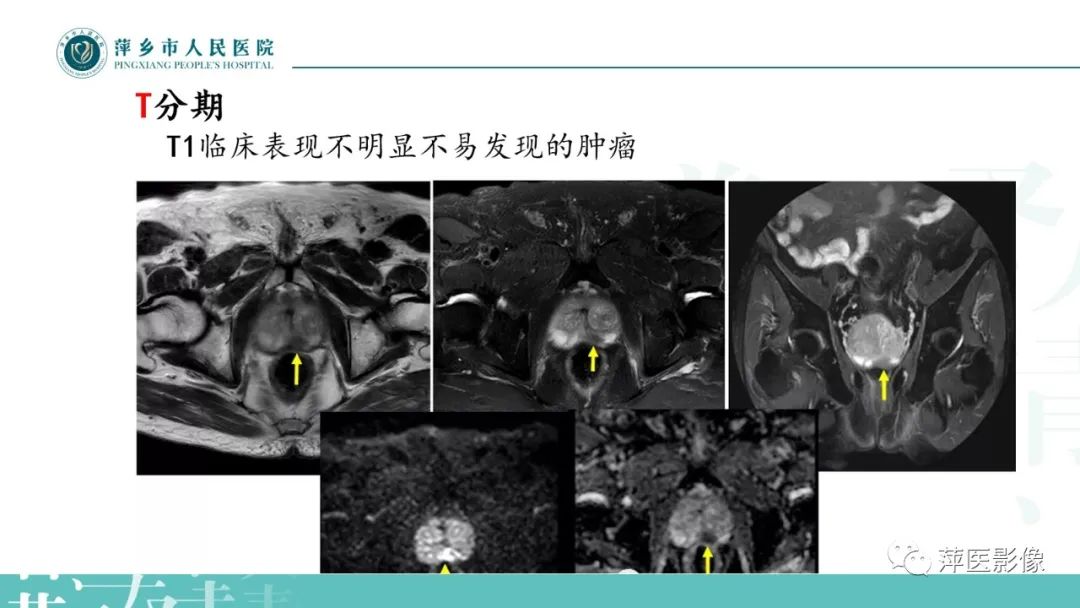 影像PPT - 【PPT】前列腺癌影像诊断-32