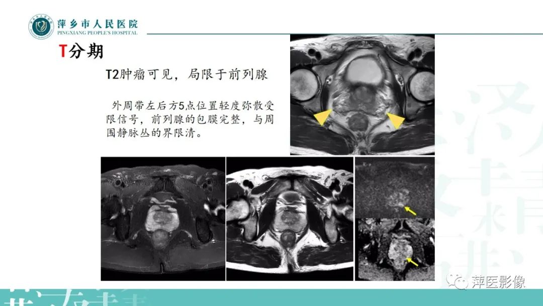 影像PPT - 【PPT】前列腺癌影像诊断-33