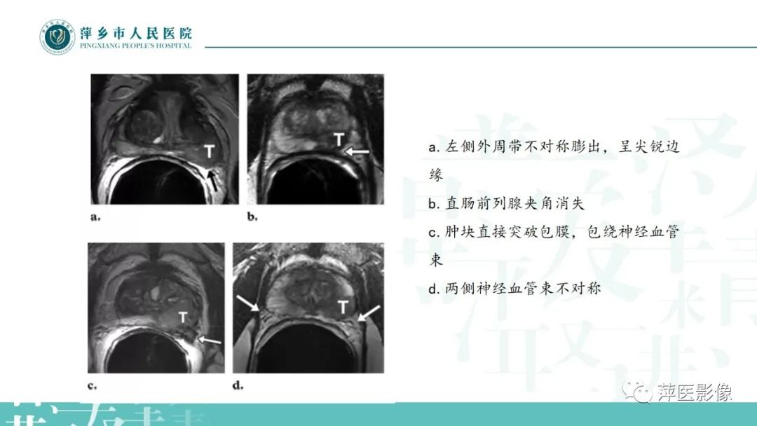 影像PPT - 【PPT】前列腺癌影像诊断-35