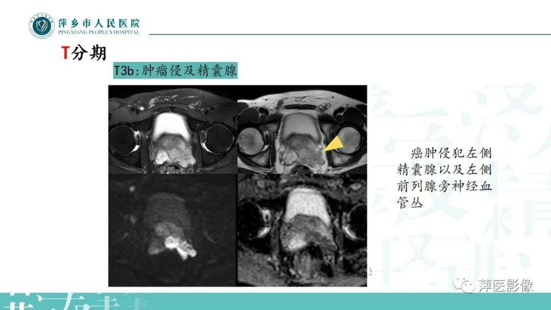 影像PPT - 【PPT】前列腺癌影像诊断-37