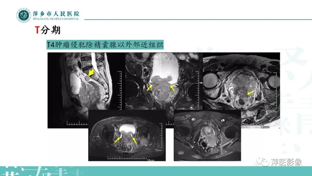 影像PPT - 【PPT】前列腺癌影像诊断-38