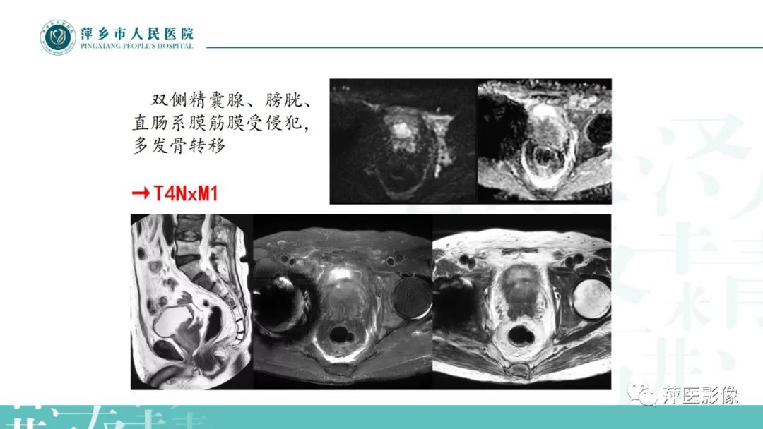 影像PPT - 【PPT】前列腺癌影像诊断-39