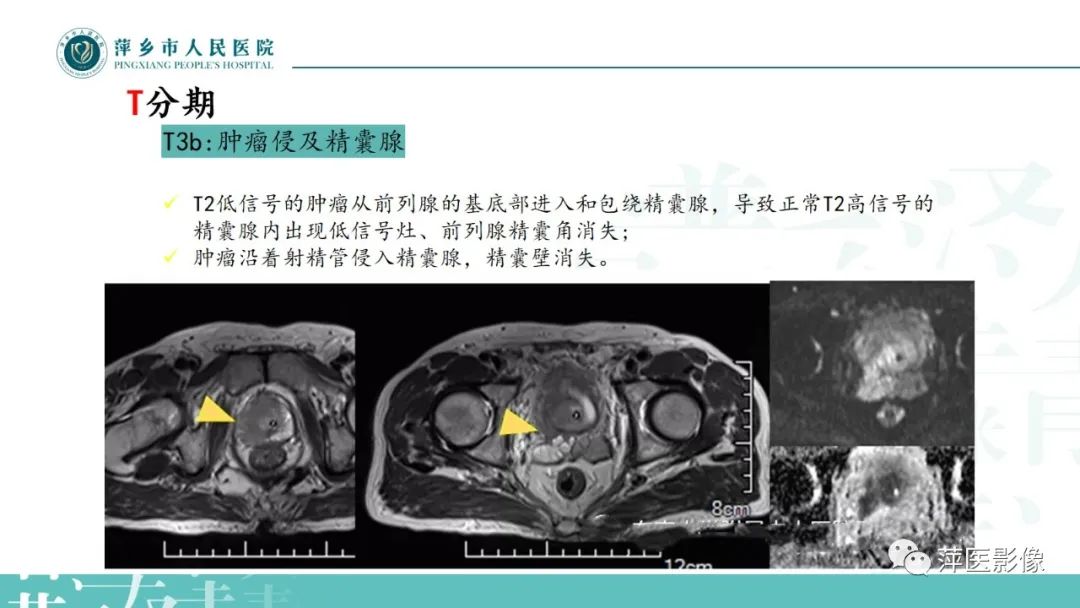 影像PPT - 【PPT】前列腺癌影像诊断-36