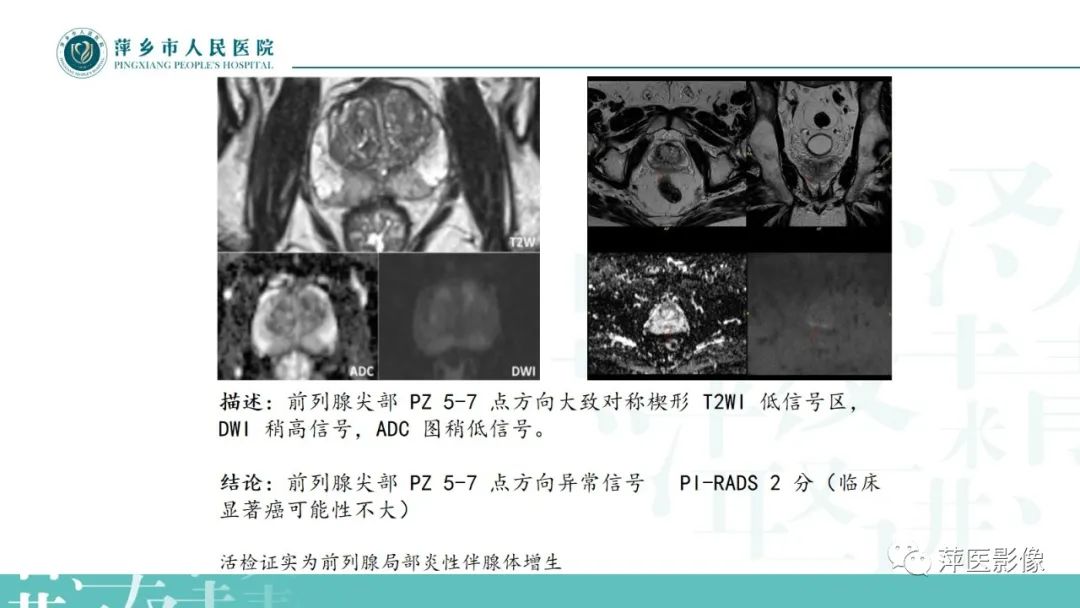 影像PPT - 【PPT】前列腺癌影像诊断-43