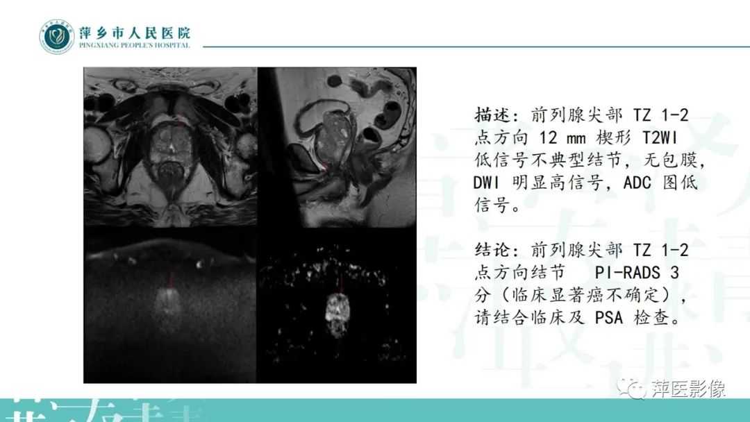 影像PPT - 【PPT】前列腺癌影像诊断-44
