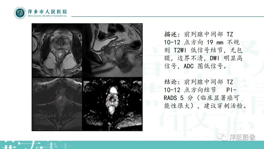影像PPT - 【PPT】前列腺癌影像诊断-45