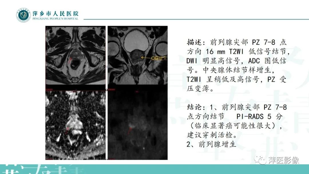 影像PPT - 【PPT】前列腺癌影像诊断-46