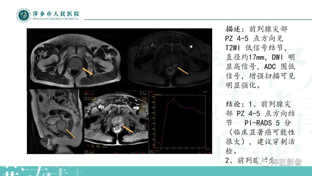 影像PPT - 【PPT】前列腺癌影像诊断-47
