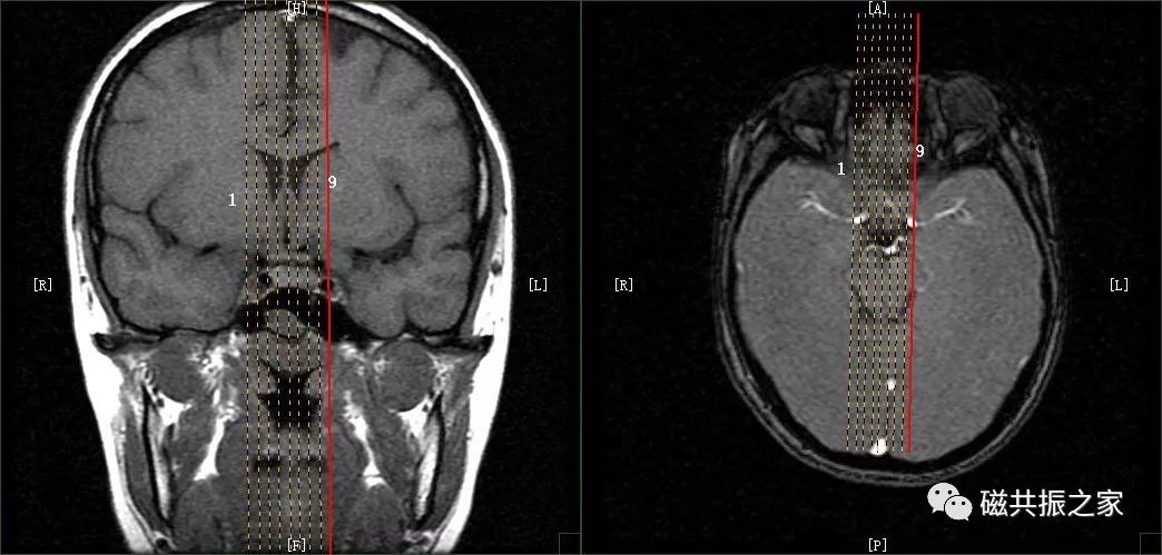 影像PPT - 掌握这些MRI技巧,扫描事半功倍-14 影像PPT - 掌握这些MRI技巧,扫描事半功倍-14