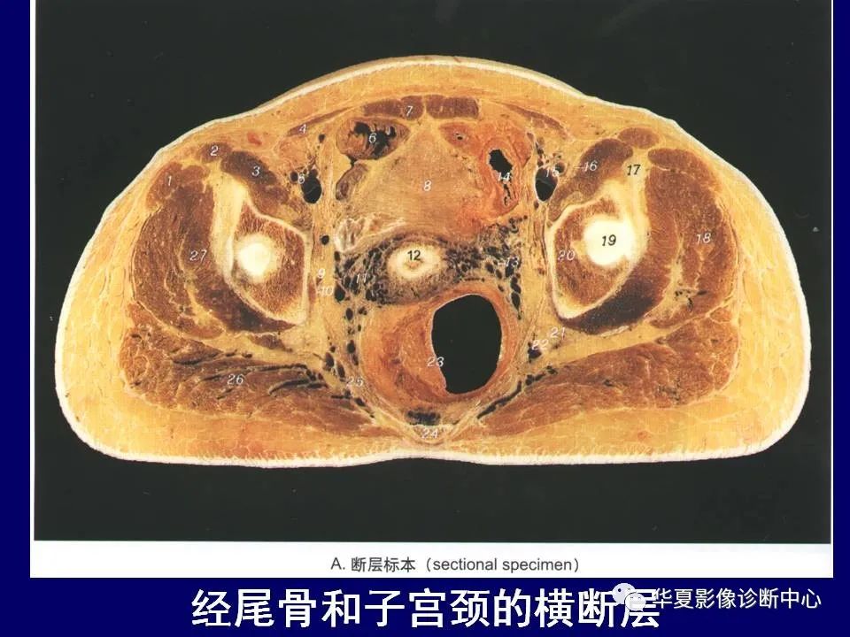 影像PPT - 【PPT】下肢的断层解剖-13