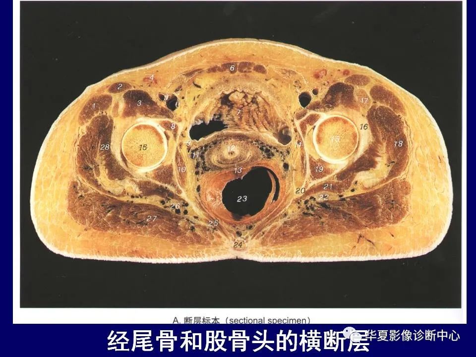 影像PPT - 【PPT】下肢的断层解剖-17