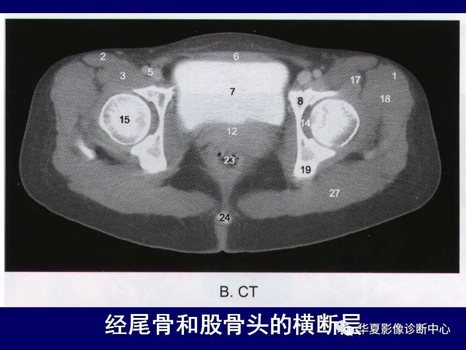 影像PPT - 【PPT】下肢的断层解剖-18