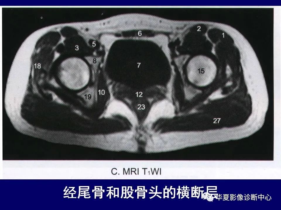影像PPT - 【PPT】下肢的断层解剖-19