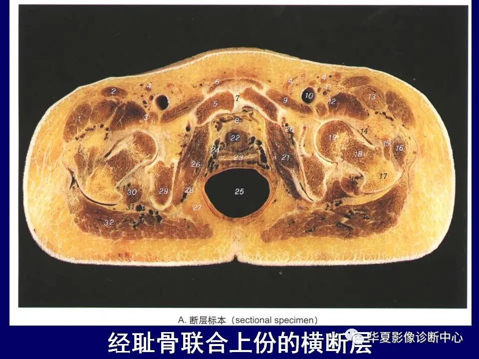 影像PPT - 【PPT】下肢的断层解剖-25