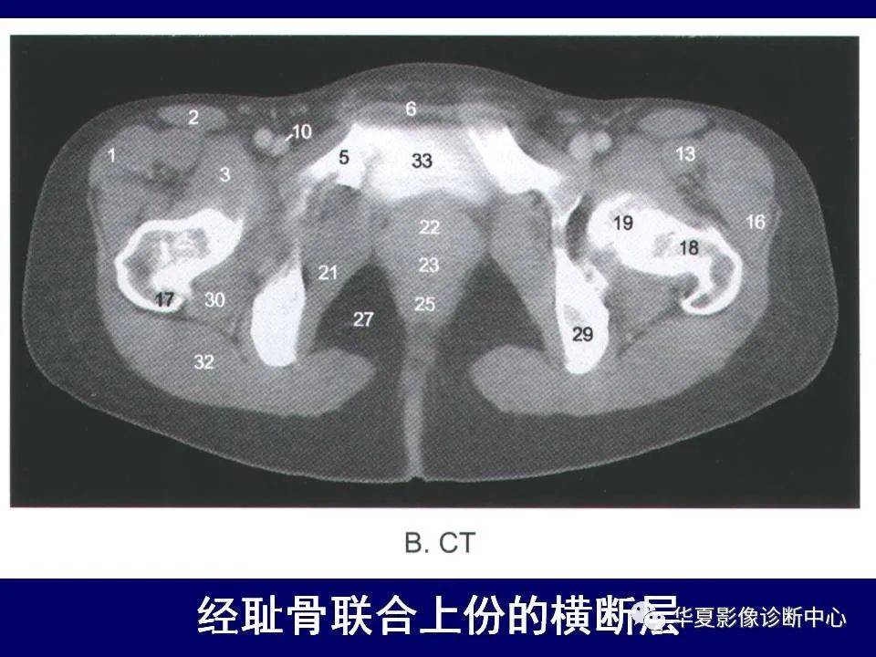 影像PPT - 【PPT】下肢的断层解剖-26