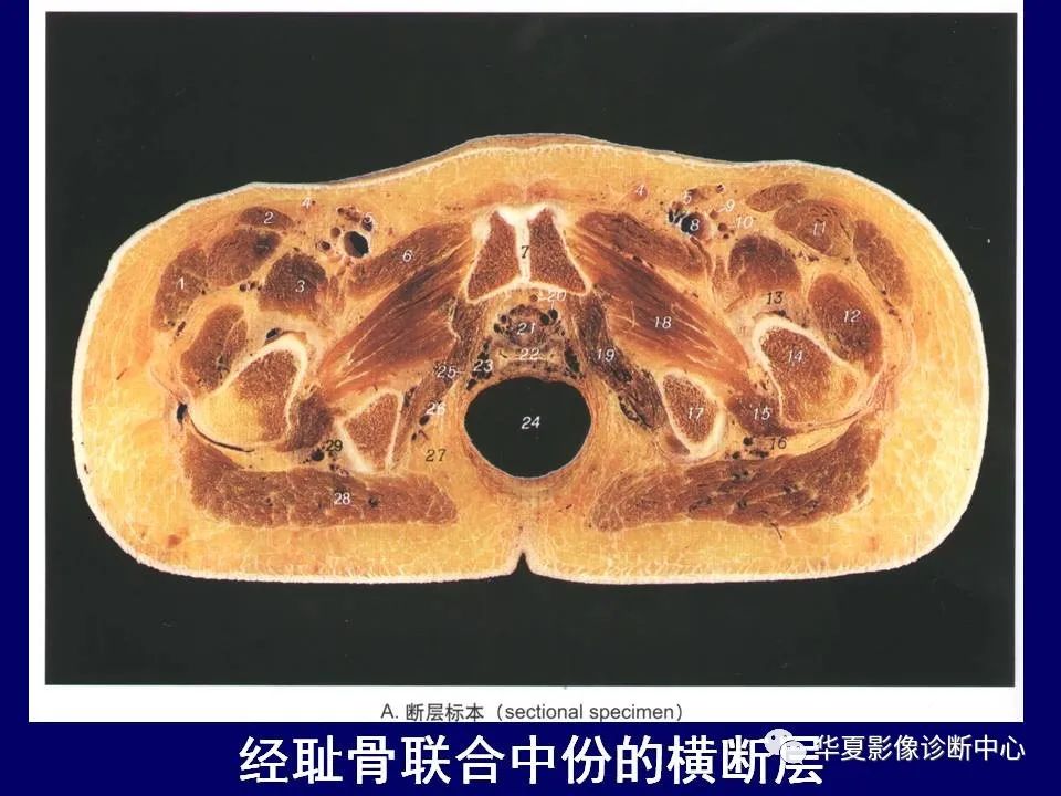 影像PPT - 【PPT】下肢的断层解剖-29