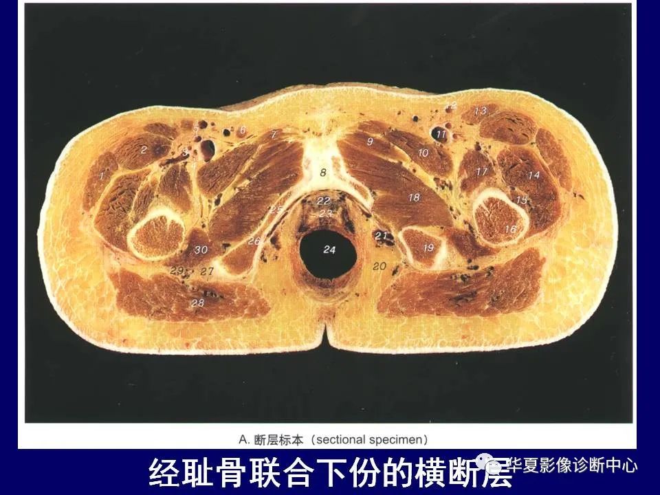 影像PPT - 【PPT】下肢的断层解剖-33