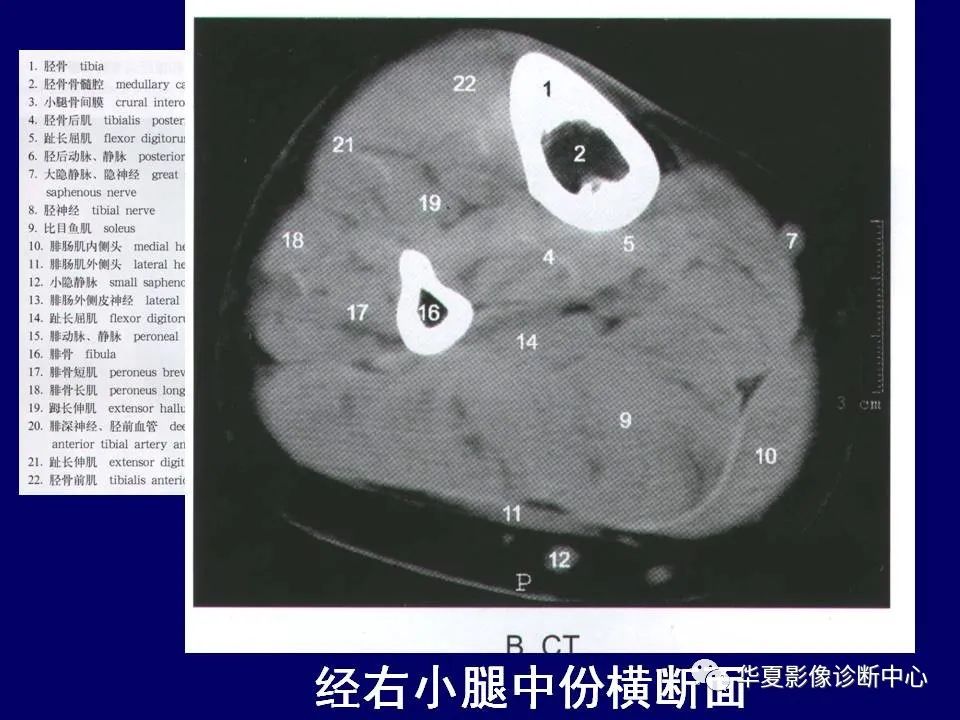 影像PPT - 【PPT】下肢的断层解剖-63