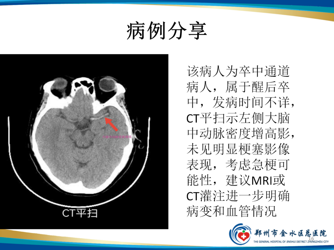 影像PPT - 【PPT】“中风”超时间窗的TA还有救么？-16