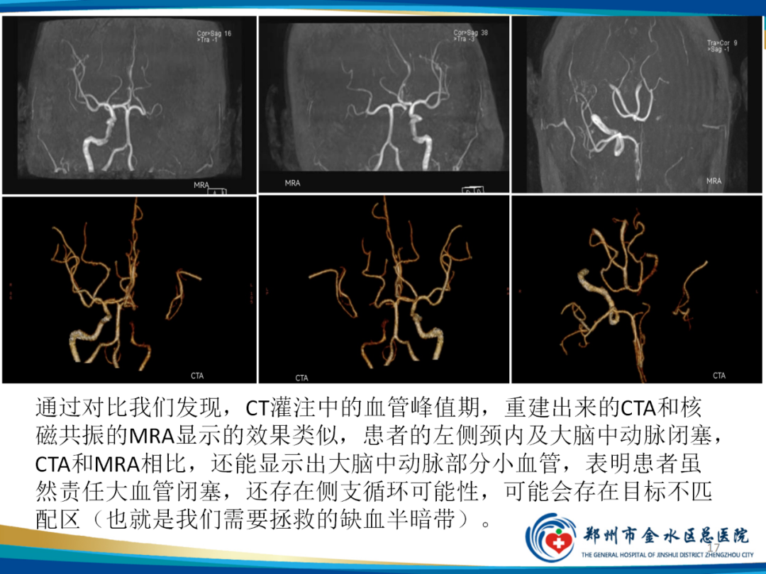 影像PPT - 【PPT】“中风”超时间窗的TA还有救么？-17